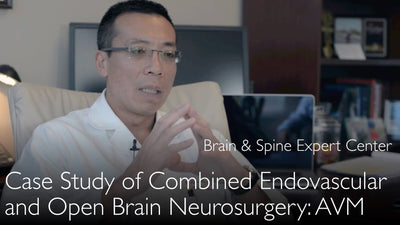 Komplexes Hirnaneurysma: Endovaskuläre und offene neurochirurgische Behandlung. Klinischer Fallbericht. 4