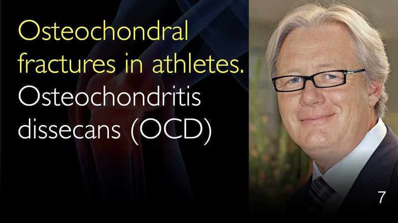 Osteochondrale Frakturen bei Sportlern. OCD, Osteochondritis dissecans. 7
